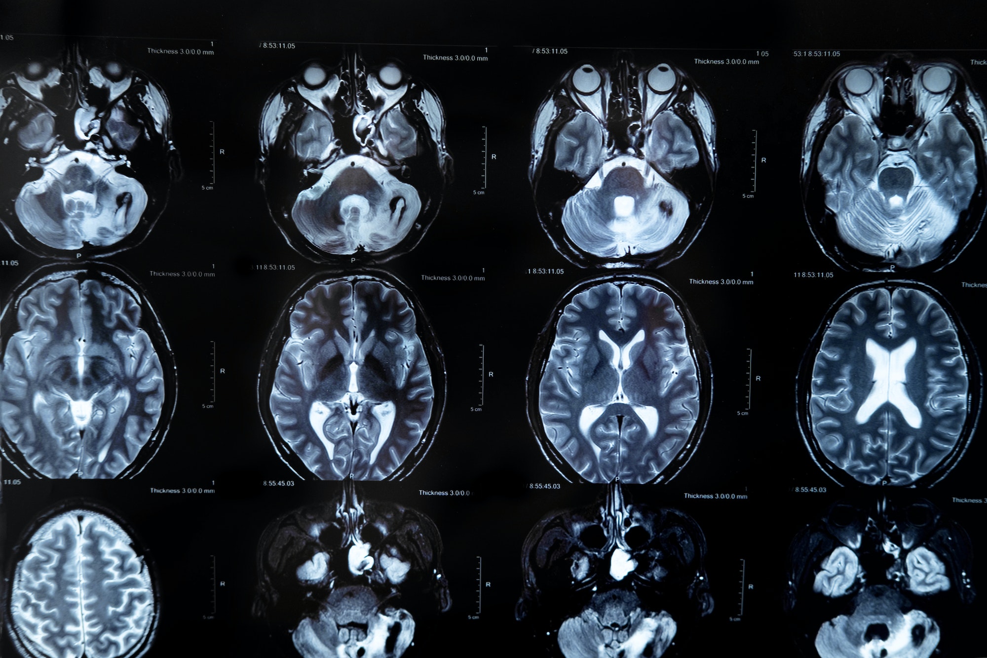 mri with brain tumor. Magnetic resonance imaging.